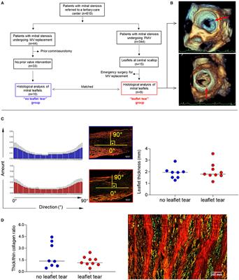 Proinflammatory Matrix Metalloproteinase-1 Associates With Mitral Valve Leaflet Disruption Following Percutaneous Mitral Valvuloplasty